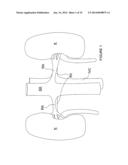 Apparatuses for Renal Neuromodulation diagram and image