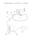 Apparatuses for Renal Neuromodulation diagram and image