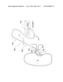 Apparatuses for Renal Neuromodulation diagram and image