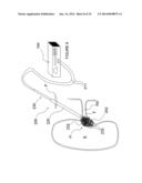 Apparatuses for Renal Neuromodulation diagram and image