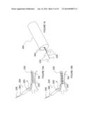 Apparatuses for Renal Neuromodulation diagram and image