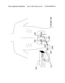 Apparatuses for Renal Neuromodulation diagram and image