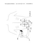 Apparatuses for Renal Neuromodulation diagram and image