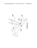 Apparatuses for Renal Neuromodulation diagram and image