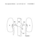 METHODS FOR MONOPOLAR RENAL NEUROMODULATION diagram and image
