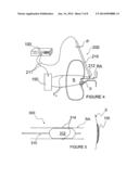 METHODS FOR MONOPOLAR RENAL NEUROMODULATION diagram and image