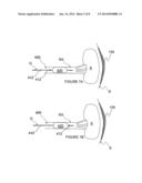 METHODS FOR MONOPOLAR RENAL NEUROMODULATION diagram and image