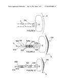 METHODS FOR MONOPOLAR RENAL NEUROMODULATION diagram and image