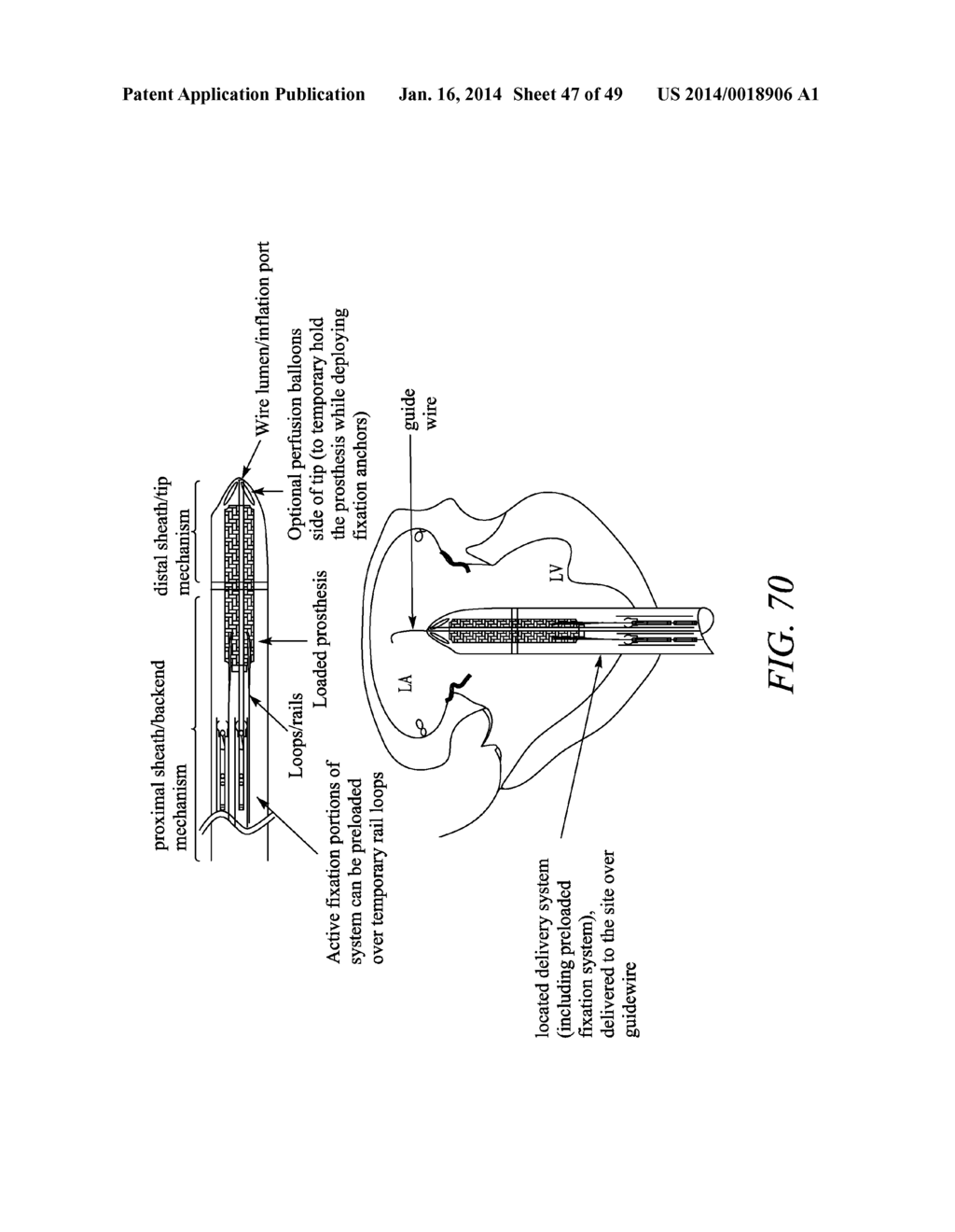 METHODS AND SYSTEMS FOR DELIVERING PROSTHESES USING RAIL TECHNIQUES - diagram, schematic, and image 48