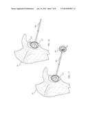 Revision Glenoid Device and Method diagram and image