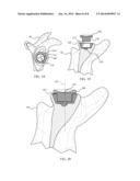 Revision Glenoid Device and Method diagram and image