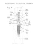 PROSTHESIS FOR ARTHRODHESIS diagram and image