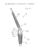 PROSTHESIS FOR ARTHRODHESIS diagram and image