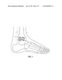 ATTACHMENTS FOR ORTHOPEDIC IMPLANTS diagram and image