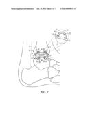 ATTACHMENTS FOR ORTHOPEDIC IMPLANTS diagram and image