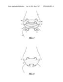 ATTACHMENTS FOR ORTHOPEDIC IMPLANTS diagram and image