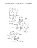 Pre-Operative Planning And Manufacturing Method For Orthopedic Procedure diagram and image