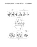 Pre-Operative Planning And Manufacturing Method For Orthopedic Procedure diagram and image