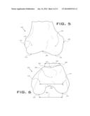 OPERATIVELY TUNING IMPLANTS FOR INCREASED PERFORMANCE diagram and image