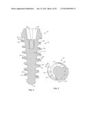 SELF-OSTEOTOMIZING BONE IMPLANT AND RELATED METHOD diagram and image