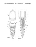 SELF-OSTEOTOMIZING BONE IMPLANT AND RELATED METHOD diagram and image