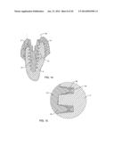 SELF-OSTEOTOMIZING BONE IMPLANT AND RELATED METHOD diagram and image