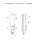 SELF-OSTEOTOMIZING BONE IMPLANT AND RELATED METHOD diagram and image