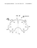 BOWEL PACKING DEVICE HAVING A SUPPORT STRUCTURE diagram and image