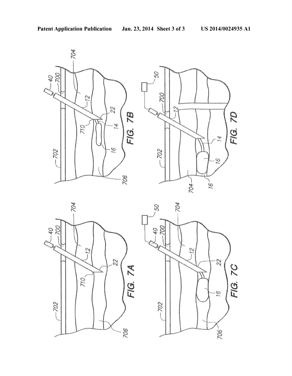 ECHOGENIC OCCLUSIVE BALLOON AND DELIVERY SYSTEM - diagram, schematic, and image 04