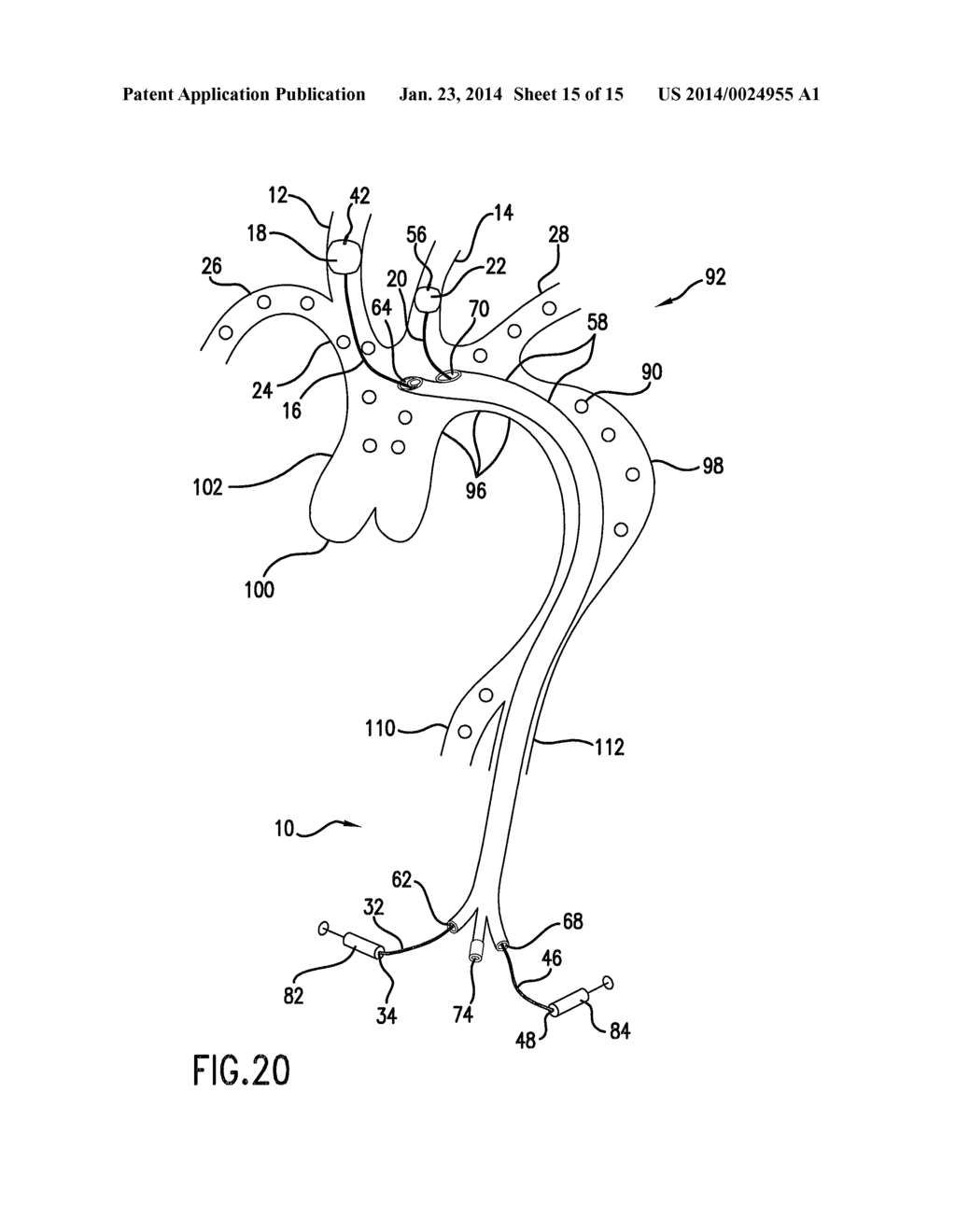 Carotid Artery Occluding Apparatus with First and Second Occluding     Balloons - diagram, schematic, and image 16