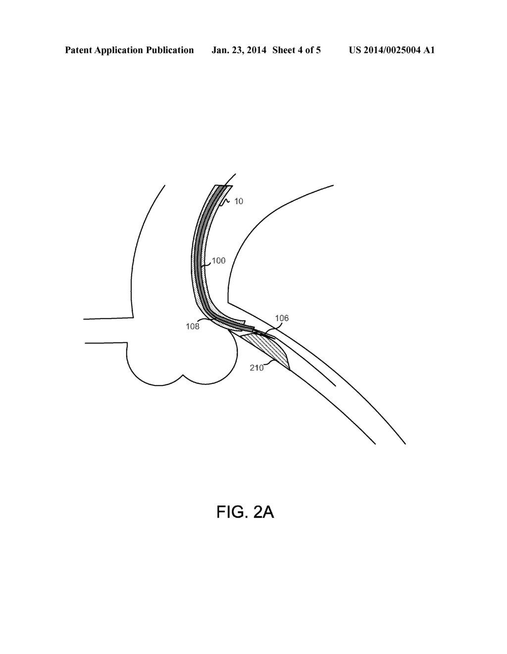 GUIDE EXTENSION CATHETER WITH TRACKABLE TIP AND RELATED METHODS OF USE - diagram, schematic, and image 05