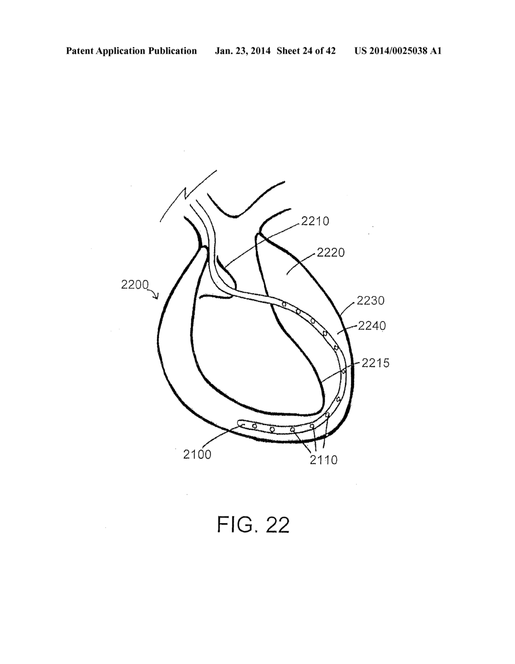 SYSTEMS, DEVICES, AND METHODS FOR TRANSEPTAL ATRIAL PUNCTURE USING AN     ENGAGEMENT CATHETER PLATFORM - diagram, schematic, and image 25