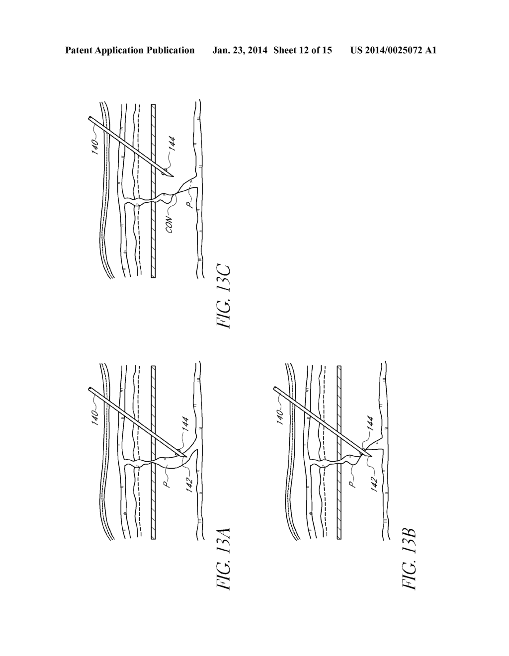 METHODS AND APPARATUS FOR COAGULATING AND/OR CONSTRICTING HOLLOW     ANATOMICAL STRUCTURES - diagram, schematic, and image 13