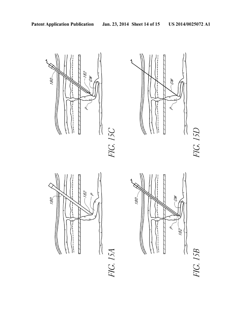 METHODS AND APPARATUS FOR COAGULATING AND/OR CONSTRICTING HOLLOW     ANATOMICAL STRUCTURES - diagram, schematic, and image 15