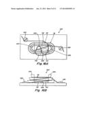 DOUBLE SPIRAL PATENT FORAMEN OVALE CLOSURE CLAMP diagram and image