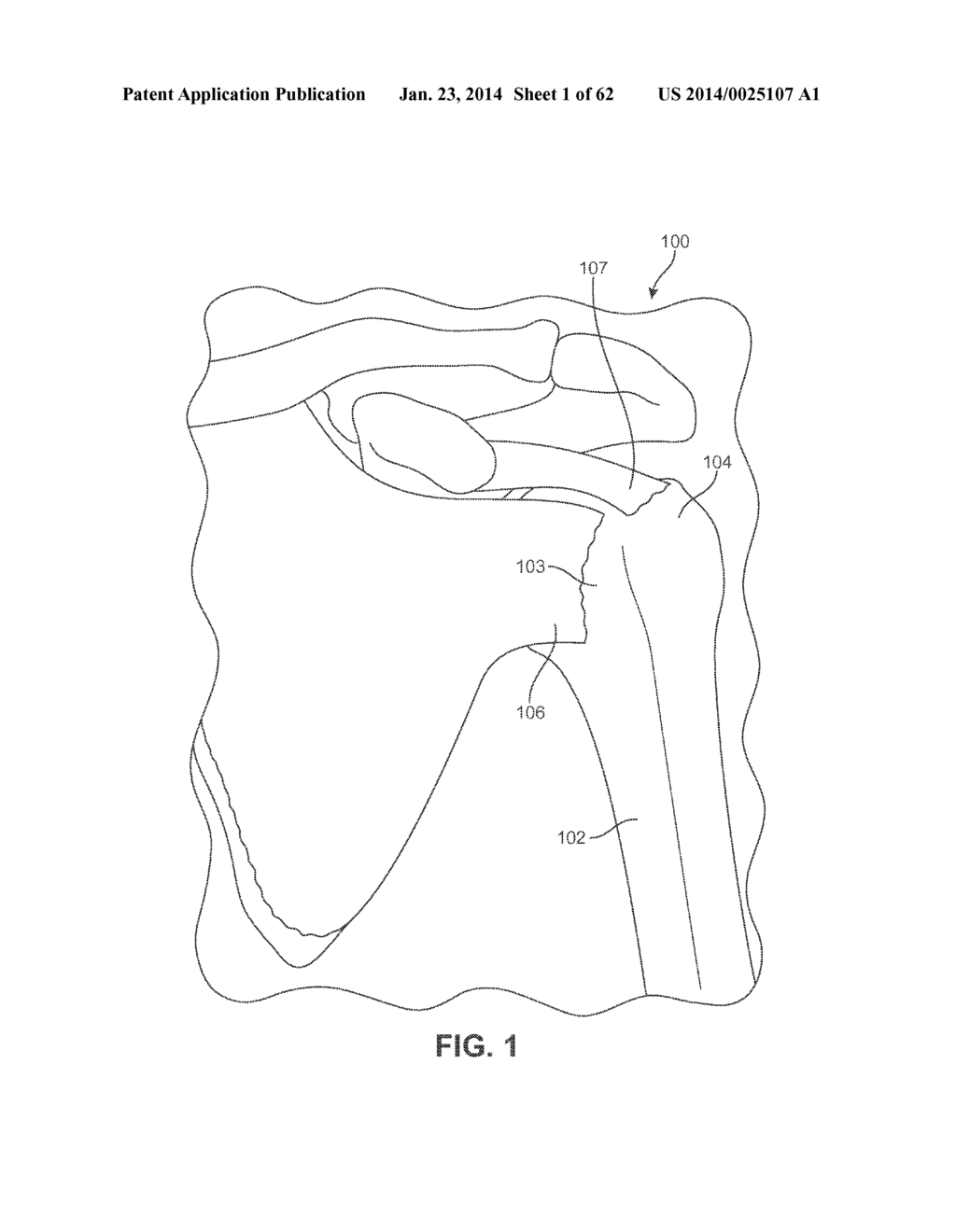 Detachable Front Delivery Assembly for a Tissue Repair System - diagram, schematic, and image 02