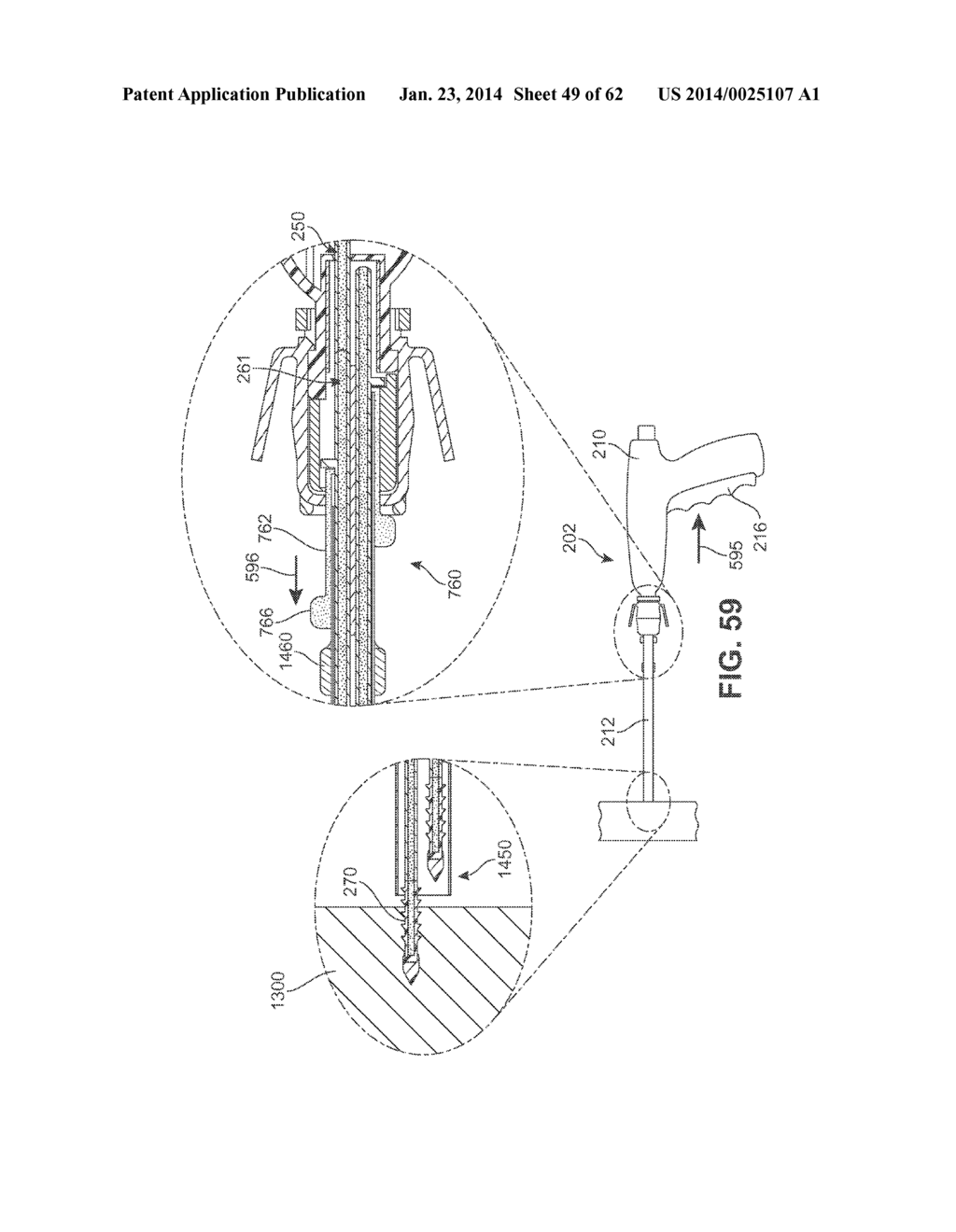 Detachable Front Delivery Assembly for a Tissue Repair System - diagram, schematic, and image 50