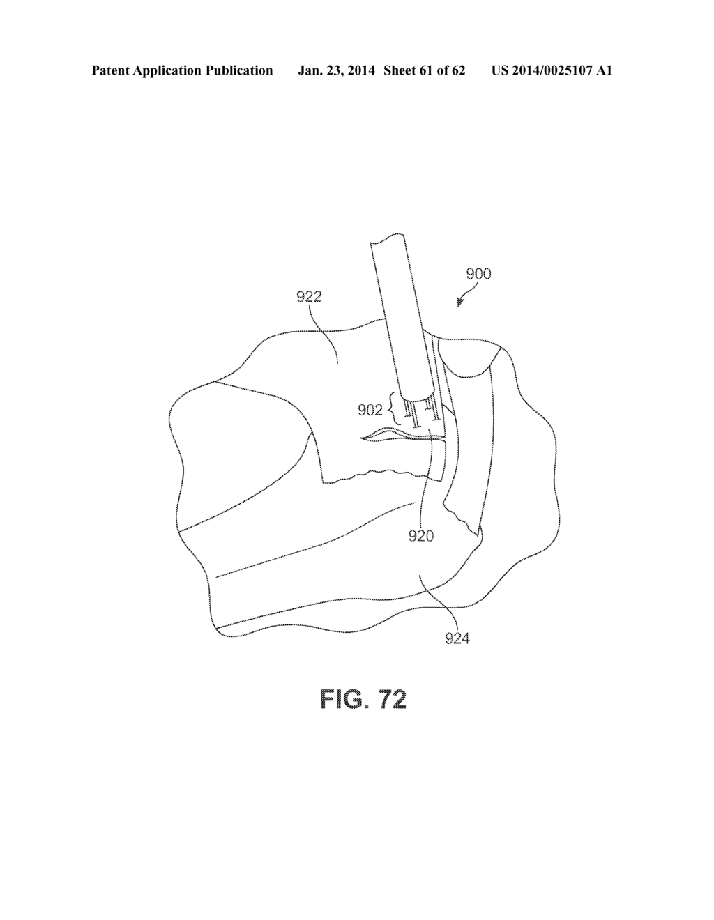 Detachable Front Delivery Assembly for a Tissue Repair System - diagram, schematic, and image 62