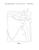 Multi-Impact System for Prosthesis Deployment Device diagram and image