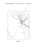 Multi-Impact System for Prosthesis Deployment Device diagram and image