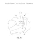 Multi-Impact System for Prosthesis Deployment Device diagram and image