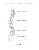 SPINAL IMPLANT diagram and image