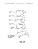 SPINAL IMPLANT diagram and image