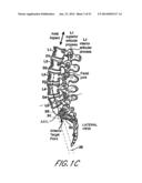 SPINAL IMPLANT diagram and image