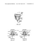 SPINAL IMPLANT diagram and image