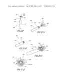 SPINAL IMPLANT diagram and image