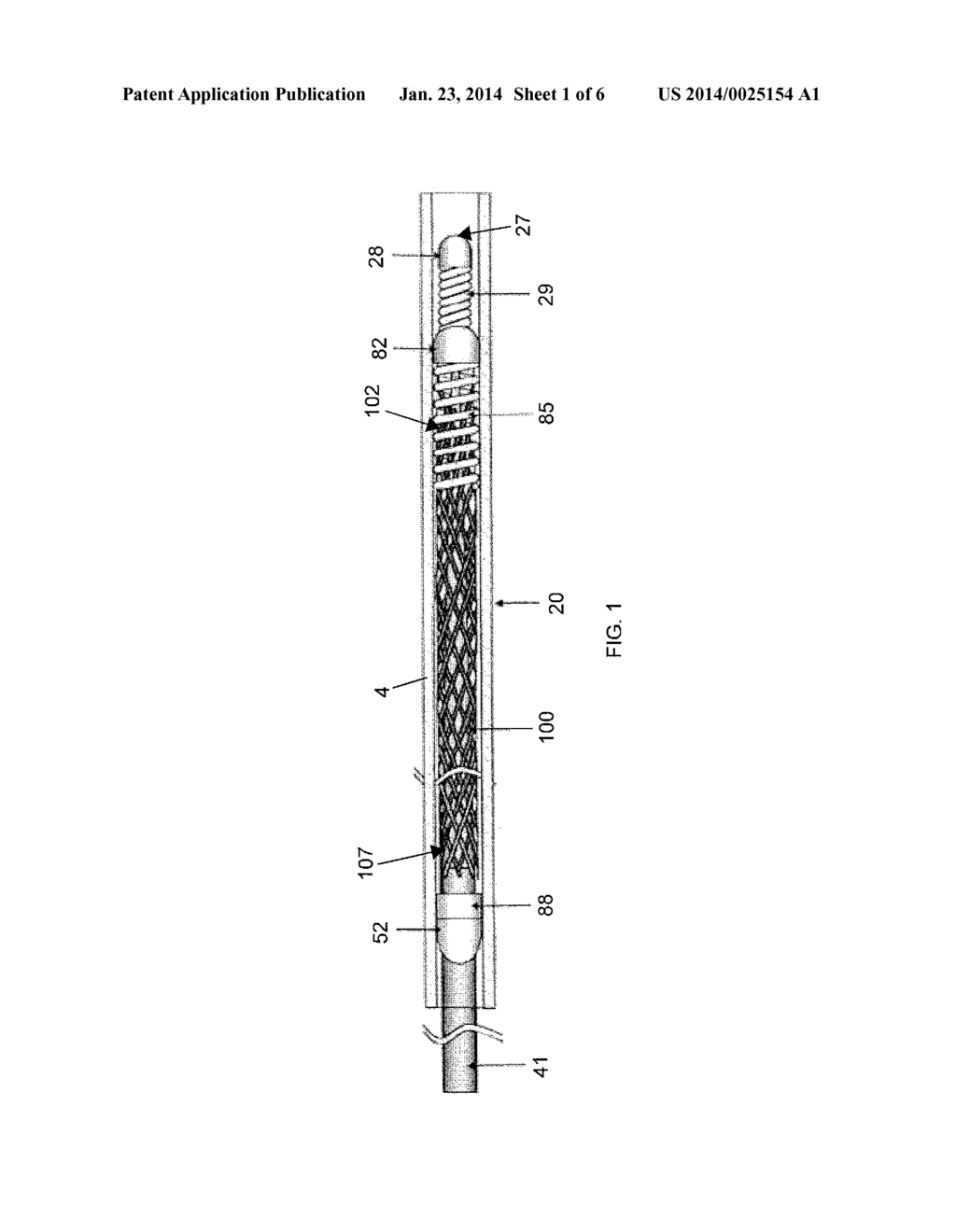 METHODS AND APPARATUS FOR LUMINAL STENTING - diagram, schematic, and image 02