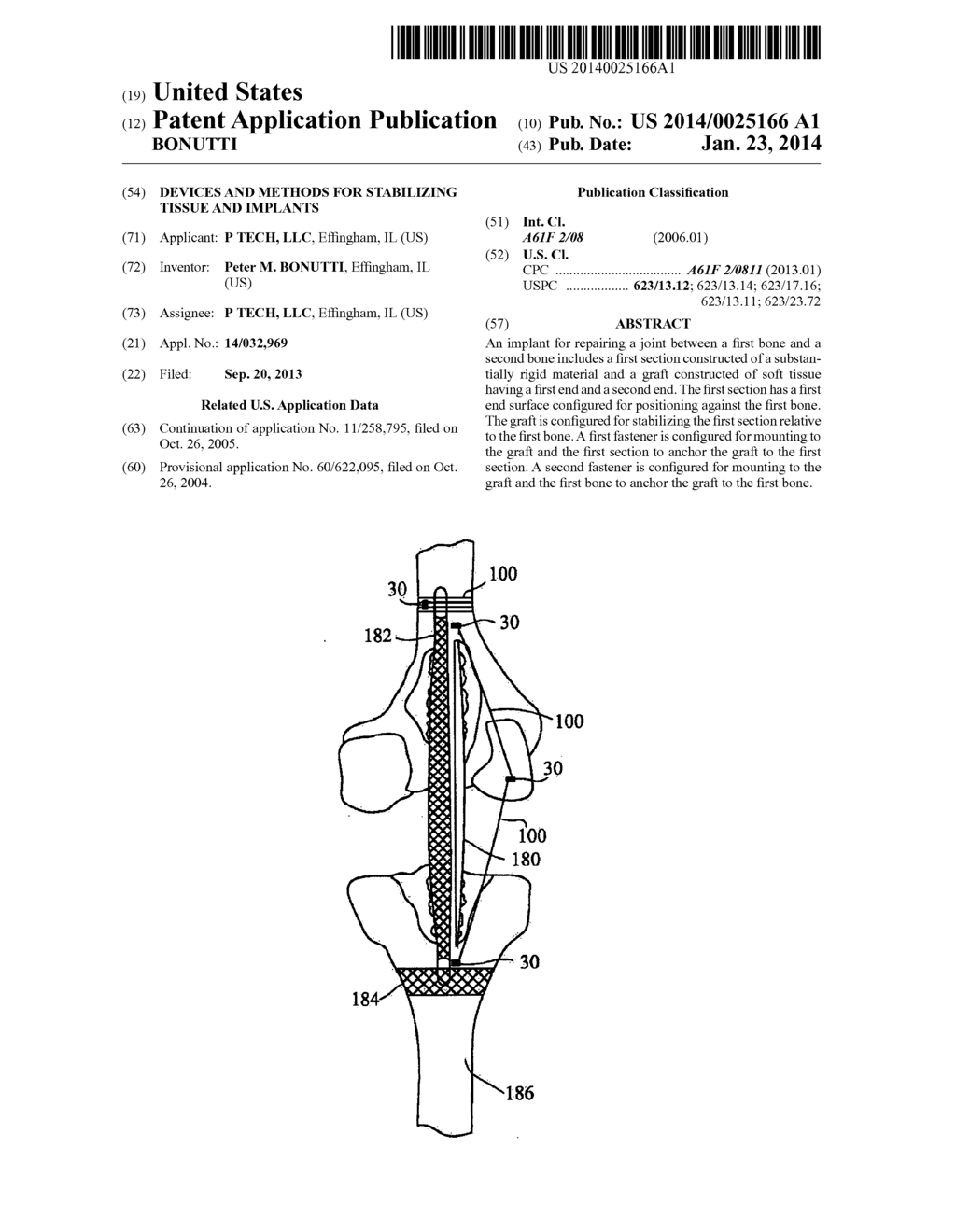 DEVICES AND METHODS FOR STABILIZING TISSUE AND IMPLANTS - diagram, schematic, and image 01