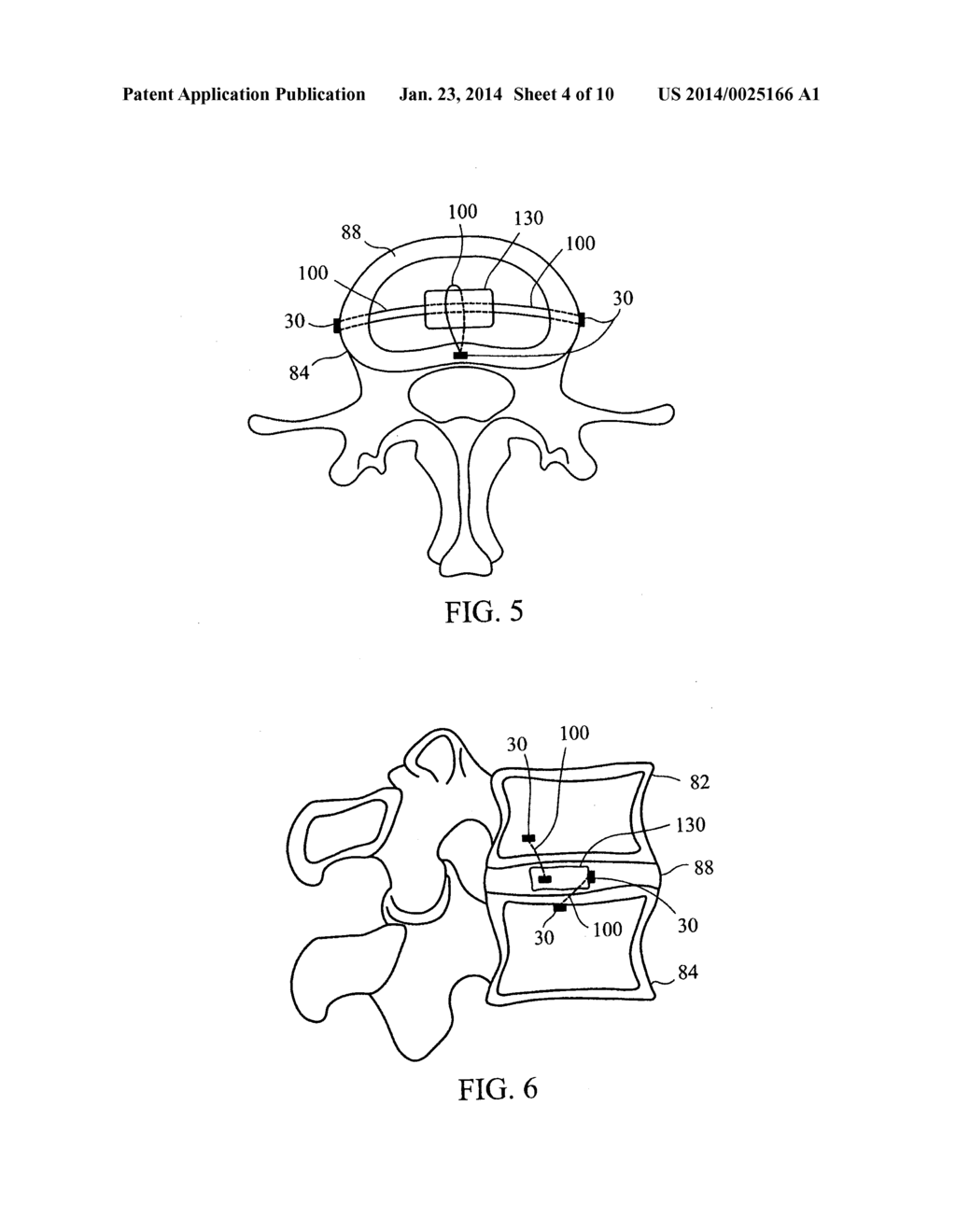 DEVICES AND METHODS FOR STABILIZING TISSUE AND IMPLANTS - diagram, schematic, and image 05