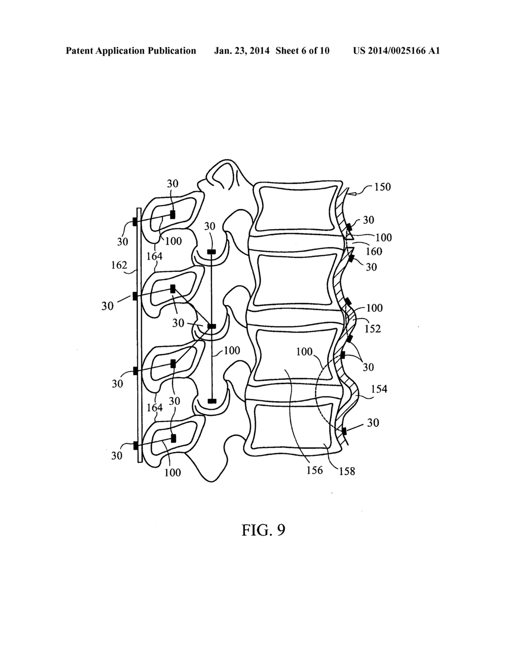 DEVICES AND METHODS FOR STABILIZING TISSUE AND IMPLANTS - diagram, schematic, and image 07